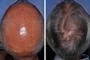 Dermatologic Hair And Sculp Treatements Port Elizabeth Balding Male Dr Gcina Mahlangeni Before After