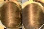Dermatologic Hair And Sculp Treatements Port Elizabeth Hair Loss Female Dr Gcina Mahlangeni Before After1