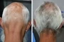Dermatologic Hair And Sculp Treatements Port Elizabeth Hair Loss Male Dr Gcina Mahlangeni Before After