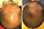 Dermatologic Hair And Sculp Treatements Port Elizabeth Hair Loss Male Dr Gcina Mahlangeni Before After1