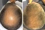 Dermatologic Hair And Sculp Treatements Port Elizabeth Hair Loss Male Dr Gcina Mahlangeni Before After2