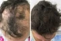 Dermatologic Hair And Sculp Treatements Port Elizabeth Male Dr Gcina Mahlangeni Before After